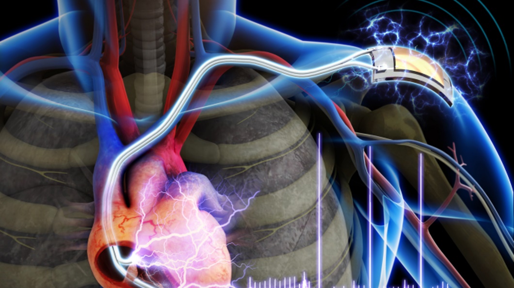 Scientists are developing next-generation battery-free implantable pacemakers that may be powered by an unlikely source – the heart itself. Image Credit: GizMag