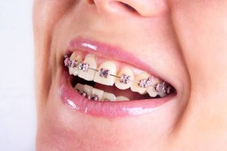 Why Patients Stop Wearing Their Braces (And What Clinicians Can Actually Do About It)