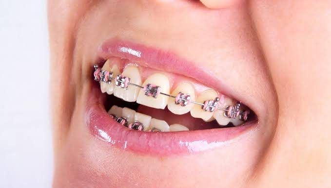 Why Patients Stop Wearing Their Braces (And What Clinicians Can Actually Do About It)